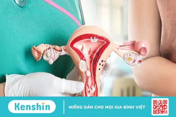 U nang buồng trứng mổ rồi có bị lại không?