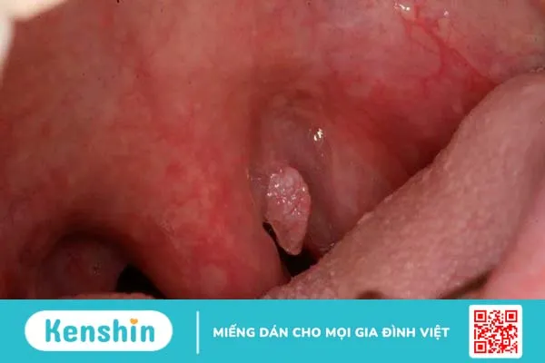 U nhú lưỡi gà và những điều cần biết