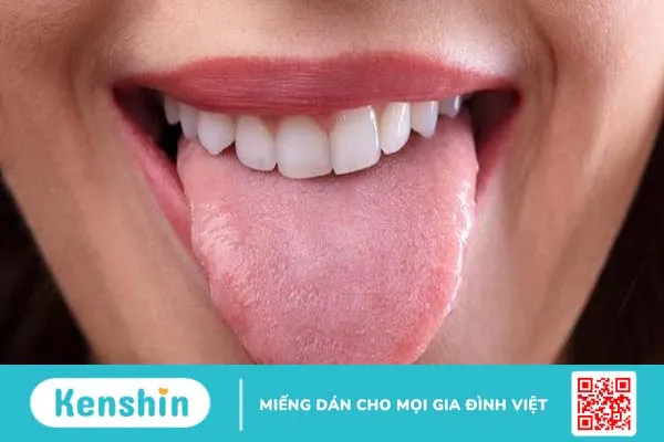 U nhú tiền đình ở miệng lưỡi: Cách điều trị và phòng tránh