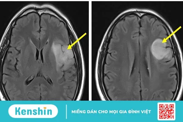 U thần kinh đệm bậc thấp là gì? Triệu chứng và cách chẩn đoán u thần kinh đệm bậc thấp