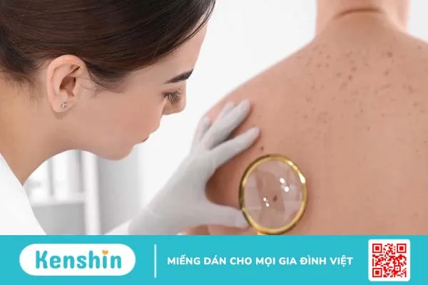 U xơ dưới da là gì? Cách phân biệt với u mỡ dưới da