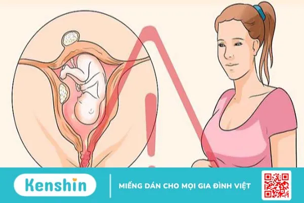 U xơ tử cung khi mang thai phải làm gì?