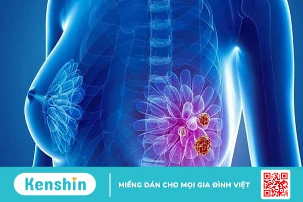 Ung thư vú HER2 thấp: Chẩn đoán và điều trị