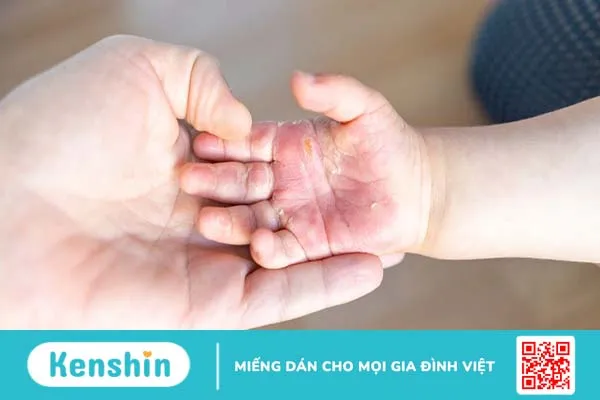 Vết bỏng bị phồng nước phải làm sao?