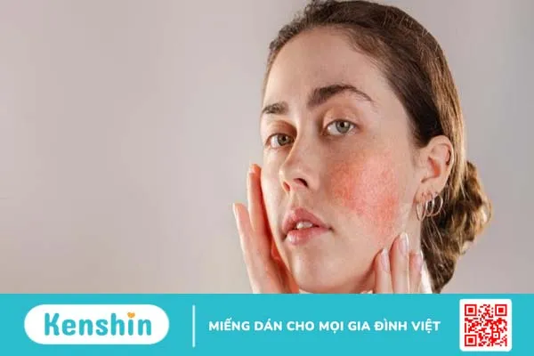 Vết chàm có di truyền không? Những điều cần biết