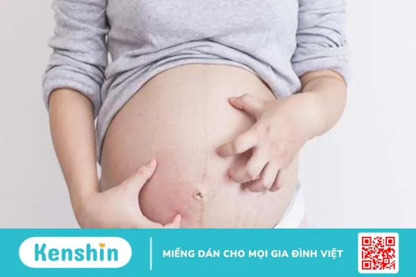 Vết rạn da sau sinh bị ngứa: Nguyên nhân và cách khắc phục