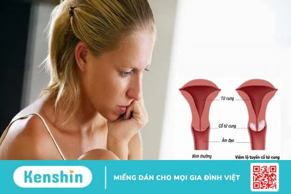 Viêm lộ tuyến cổ tử cung có nên đốt không? Khi nào nên sử dụng phương pháp “đốt”?