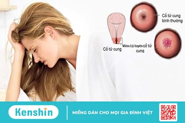 Viêm lộ tuyến cổ tử cung có tự khỏi không? Lưu ý để mau chóng khỏi bệnh