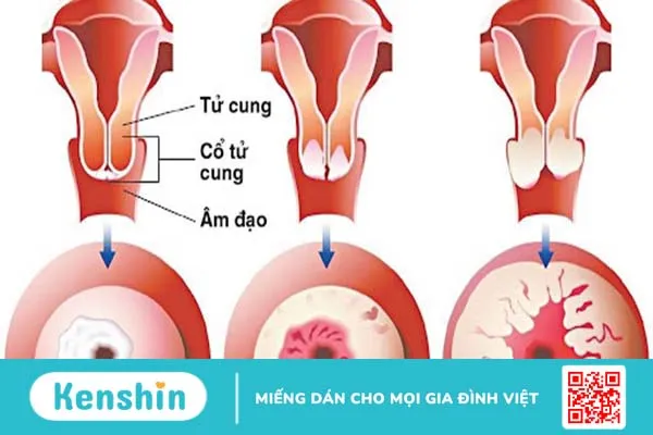 Viêm lộ tuyến tử cung có nguy hiểm không? Các phương pháp phòng chống bệnh như thế nào?