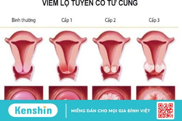 Viêm lộ tuyến tử cung uống thuốc gì cho nhanh khỏi lại an toàn?