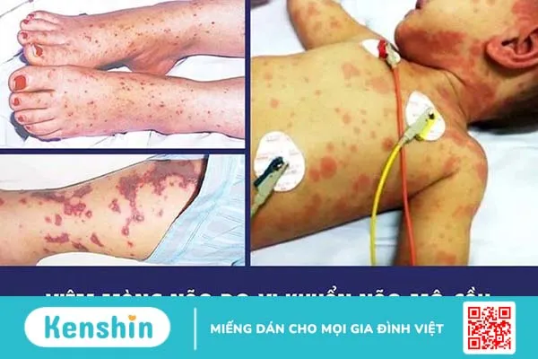 Viêm màng não có thể gây tử vong cho trẻ em trong 24 giờ