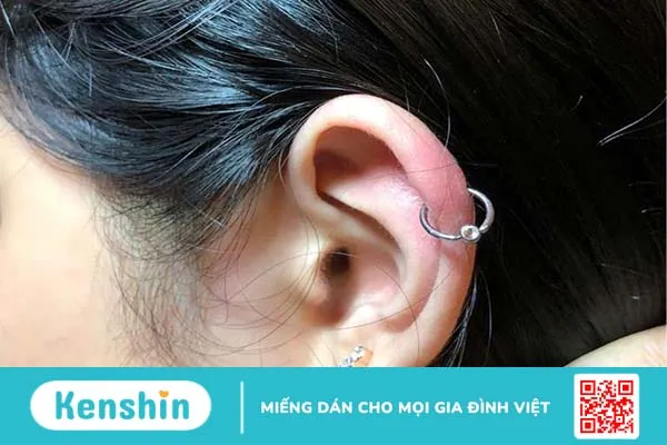 Viêm sụn vành tai là gì? Cần cẩn thận với các triệu chứng gây viêm