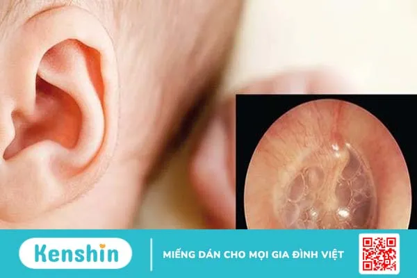 Viêm tai giữa ứ dịch: Nguyên nhân và cách điều trị hiệu quả