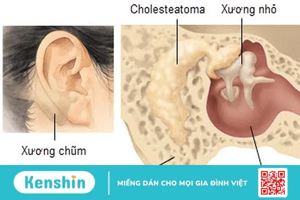 Viêm tai xương chũm là gì? Nguyên nhân, triệu chứng và cách điều trị?