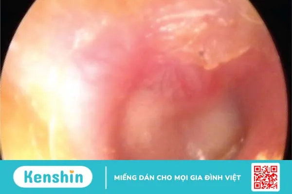 Viêm thượng nhĩ là gì? Chẩn đoán, điều trị và phòng ngừa như thế nào?