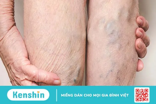 Viêm tĩnh mạch: Nguyên nhân, triệu chứng và cách điều trị bệnh