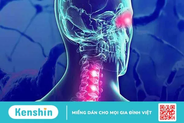 Viêm tủy thị thần kinh: Bệnh hiếm gặp gây suy giảm thị lực và liệt nửa người