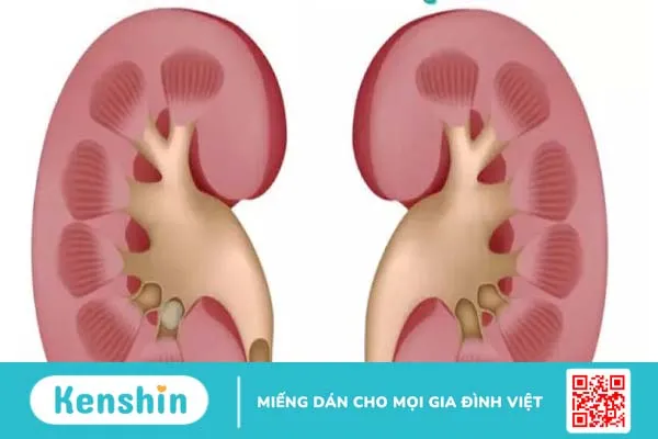 Vôi hóa thận: Nguyên nhân, triệu chứng và cách điều trị