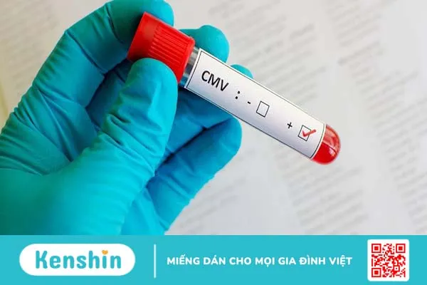 Xét nghiệm CMV phát hiện bệnh do virus Cytomegalo gây ra