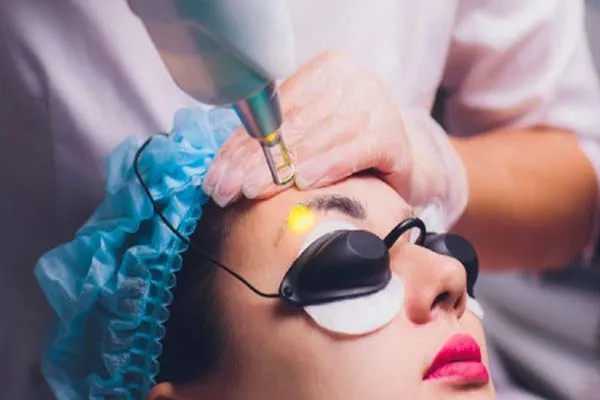 Xoá xăm chân mày bằng laser có hiệu quả không?